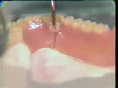 Ultra Thin Dentures Reston VA 20190